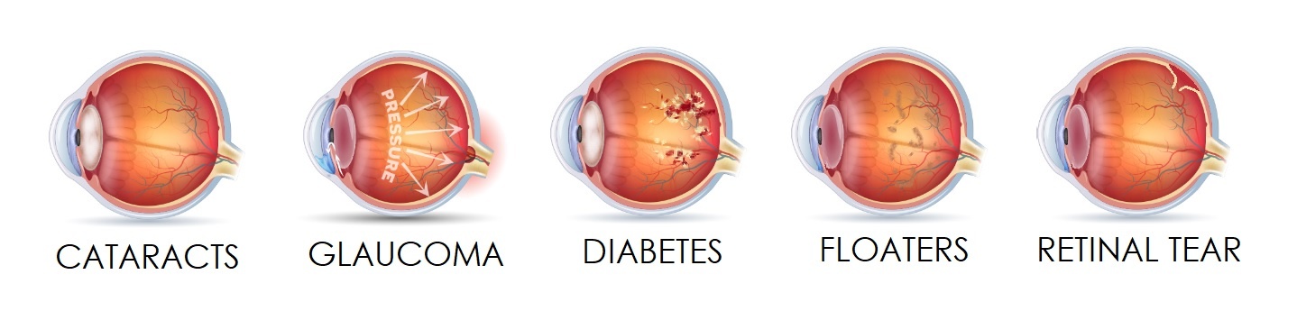 eyeconditions